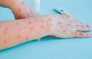 Confirma Secretaría de Salud caso de sarampión en la entidad