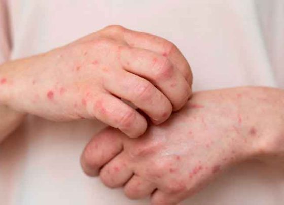 Informa Secretaría de Salud que suman cinco los casos de sarampión en el estado